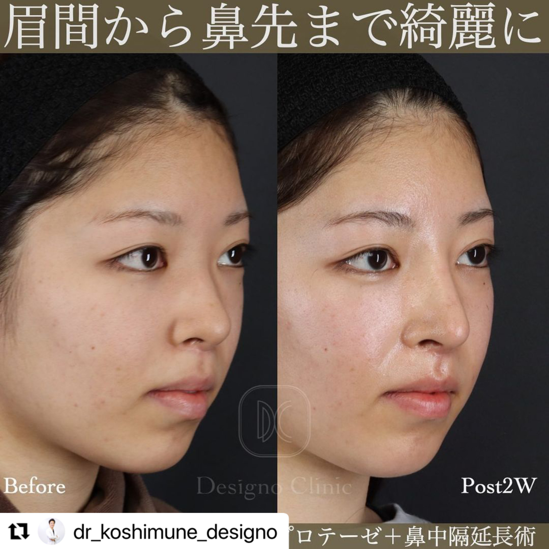眉間から鼻 – 眉間から鼻が生える – YCQRE