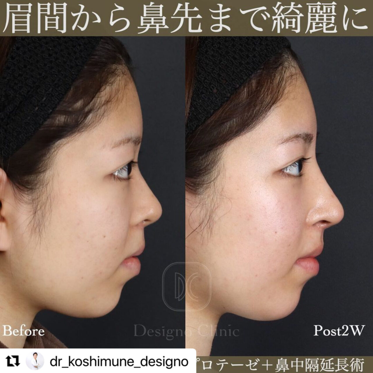 🌈眉間から鼻先まで綺麗に🌈 - デジーノクリニック