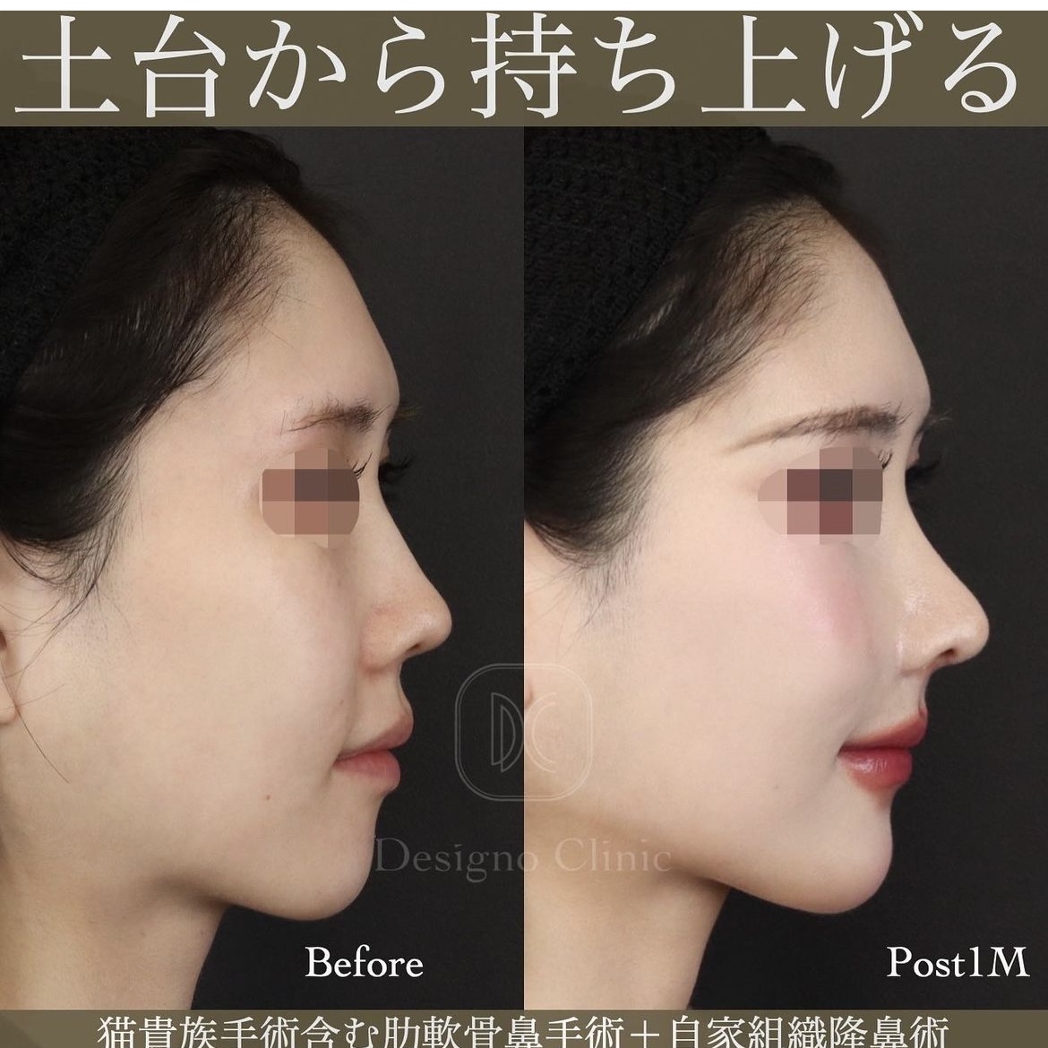 🌈お鼻の土台ごと持ち上げる鼻手術🌈 - デジーノクリニック